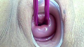 Prolapsed Cervix Lesbians at the same time