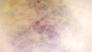 MILF Bruised Tits Self Sucking